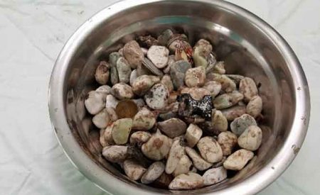 焦虑就吃鹅卵石硬币…医生从病患胃中取出2公斤石块、瓶盖和硬币